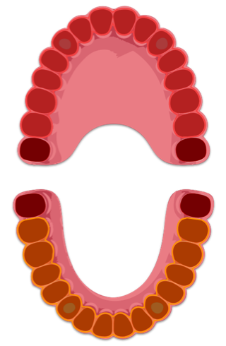 Assenza di impianti in Arcata superiore, 2 impianti in arcata inferiore con attacchi sferici per la Protesi Rimovibile Inferiore